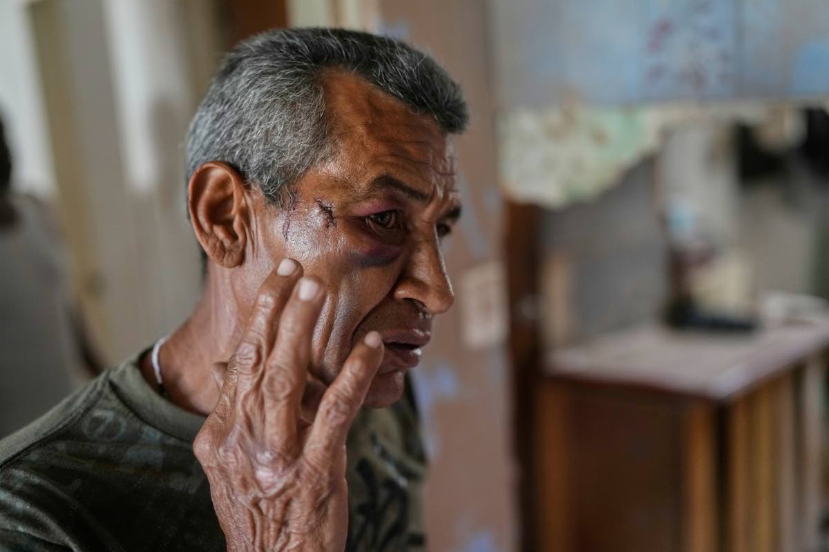 Wilman Gonzalez shows an injury he says he suffered when his home was hit during US military operations to capture Venezuelan President Nicolas Maduro in Catia La Mar, Venezuela.