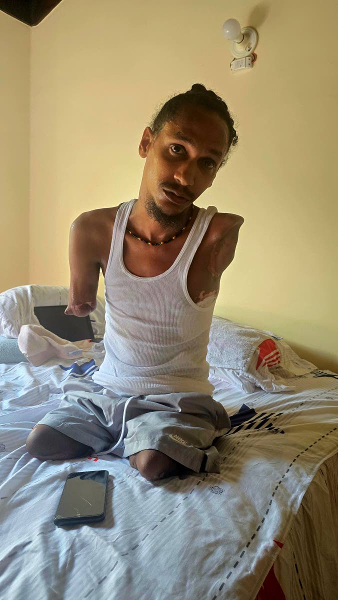 Chace Singh was left without limbs after being electrocuted a year ago.