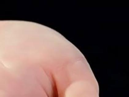 A tiny, minimally invasive device, smaller than a dime, is now helping close dangerous heart defects without the need for surgery.